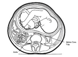 Imagen 1.- Compresión de la vena cava inferior por el útero grávido (Rubén Barakat, 2020).